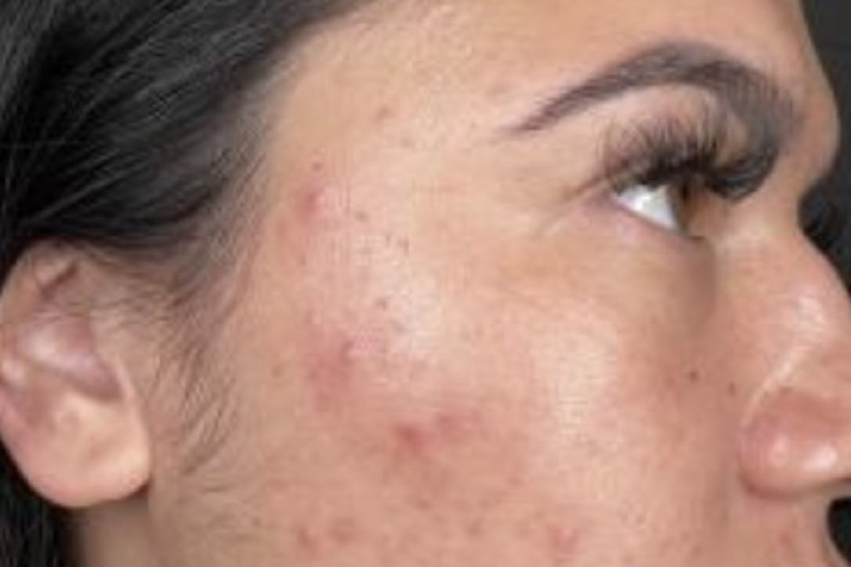 Before — Skin clarity · after a Hydrafacial course