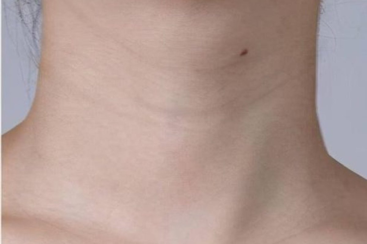 Before — Neck lines · after treatment