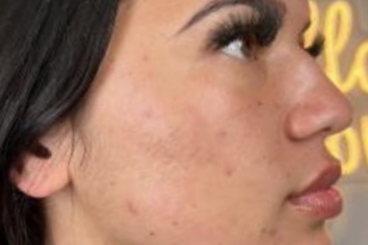 After — Skin clarity · after a Hydrafacial course
