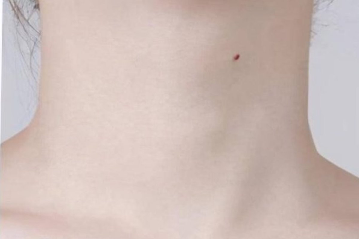 After — Neck lines · after treatment