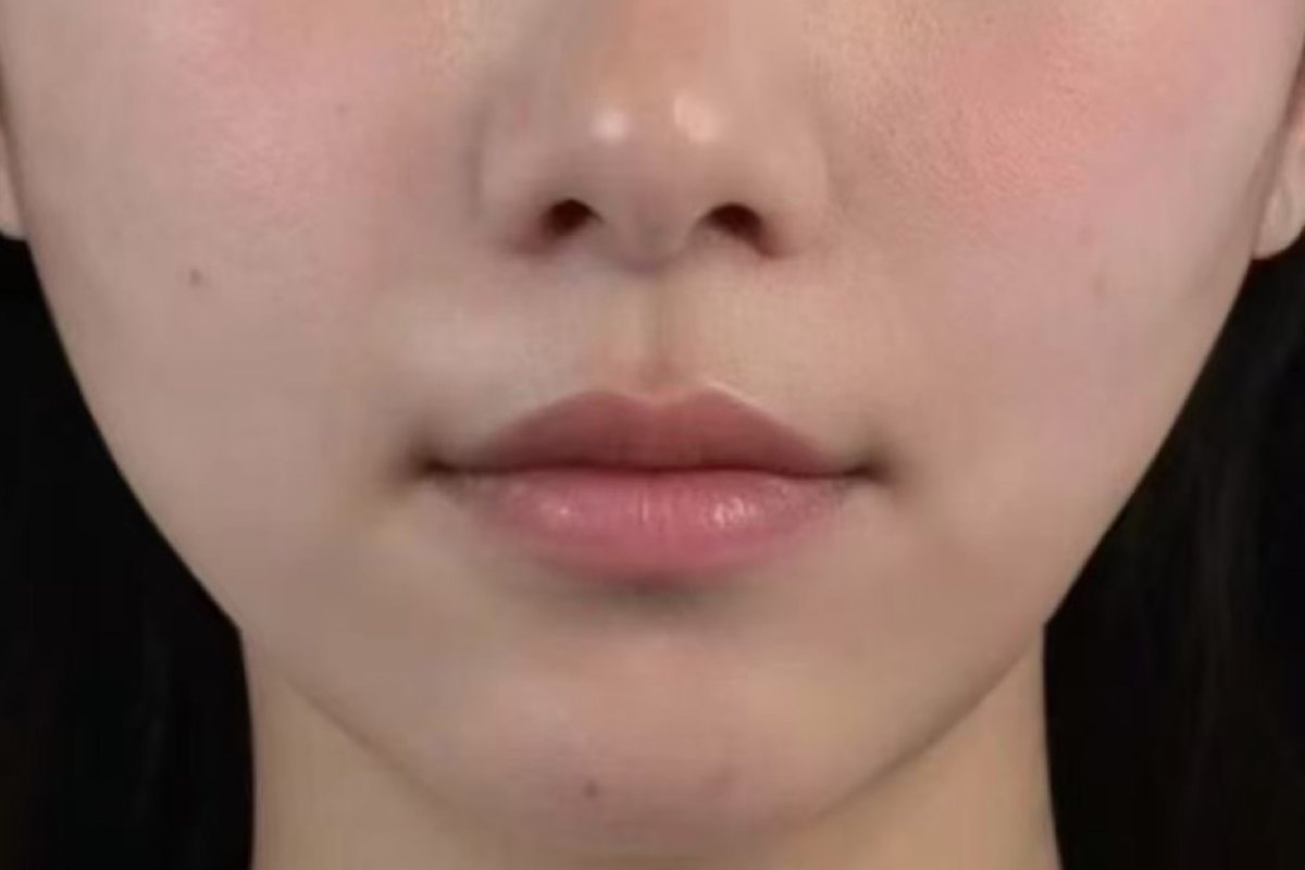 After — Jawline & chin · after treatment