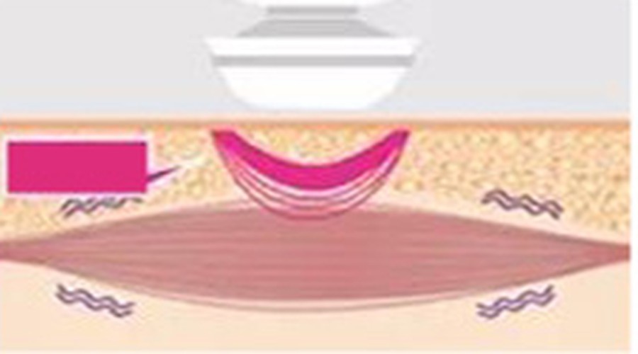 Collagen contracts