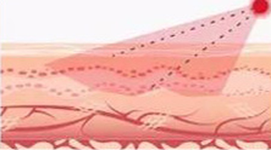 RF waves penetrate
