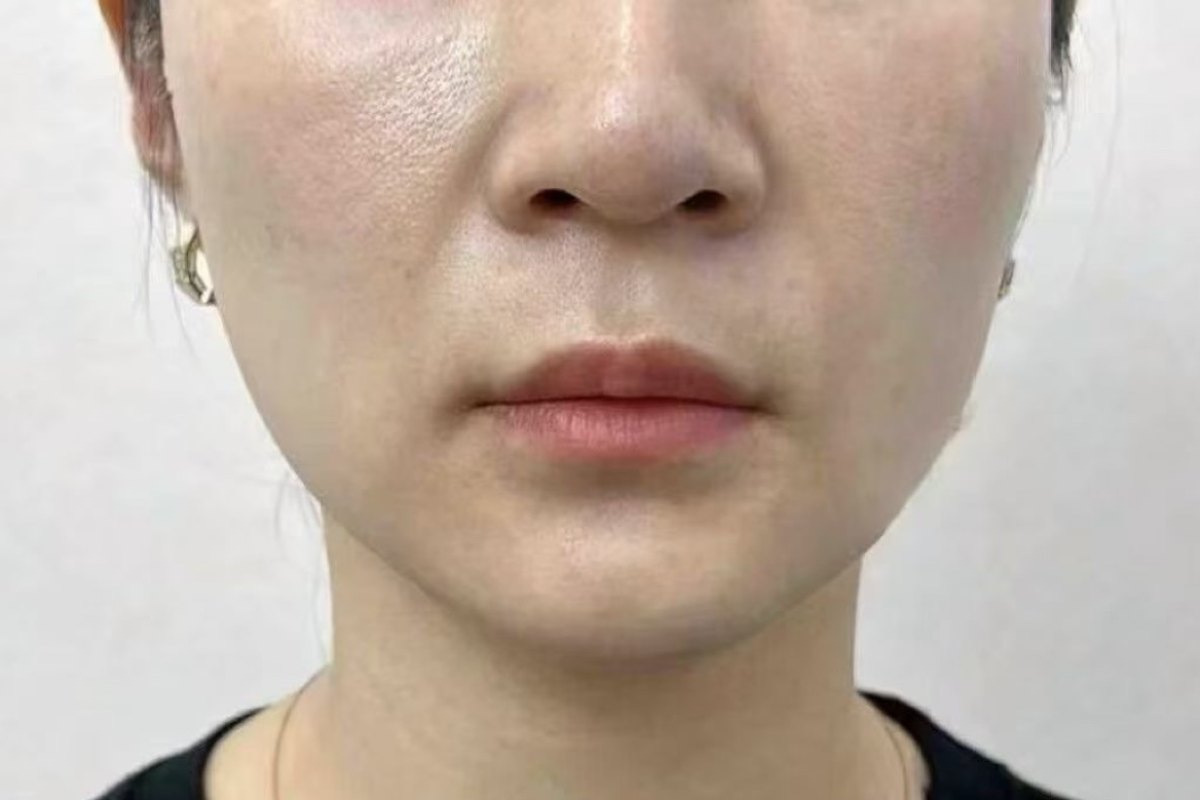 Before — Lower face · after treatment