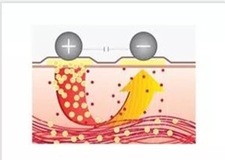 Negative-plate loop diagram