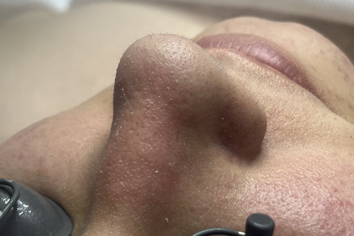 Before — Deluxe Hydrafacial with LED · same day