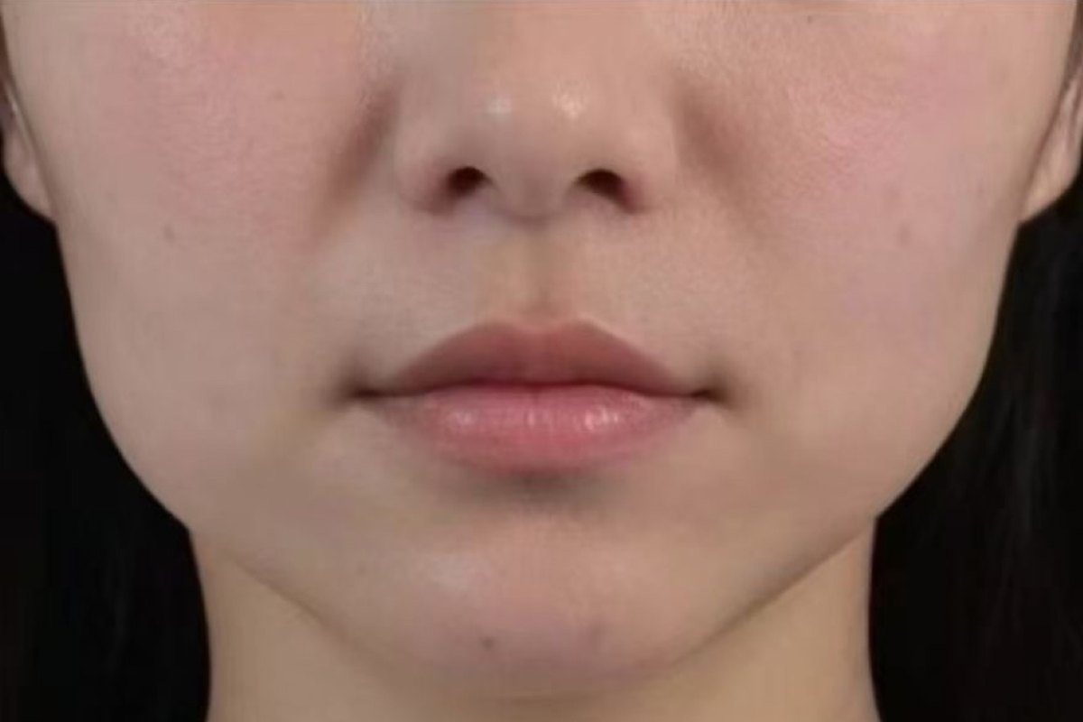 Before — Jawline & chin · after treatment
