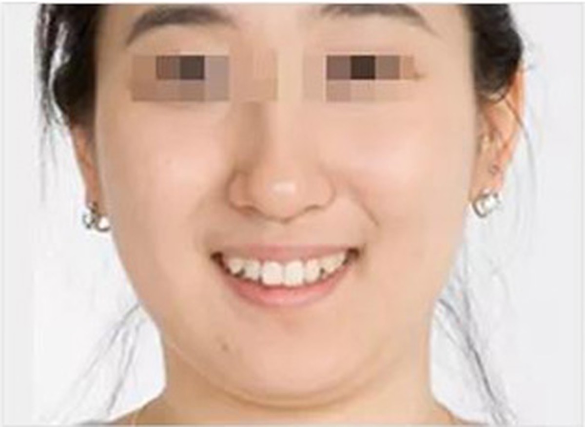 Before — Full face · V-line