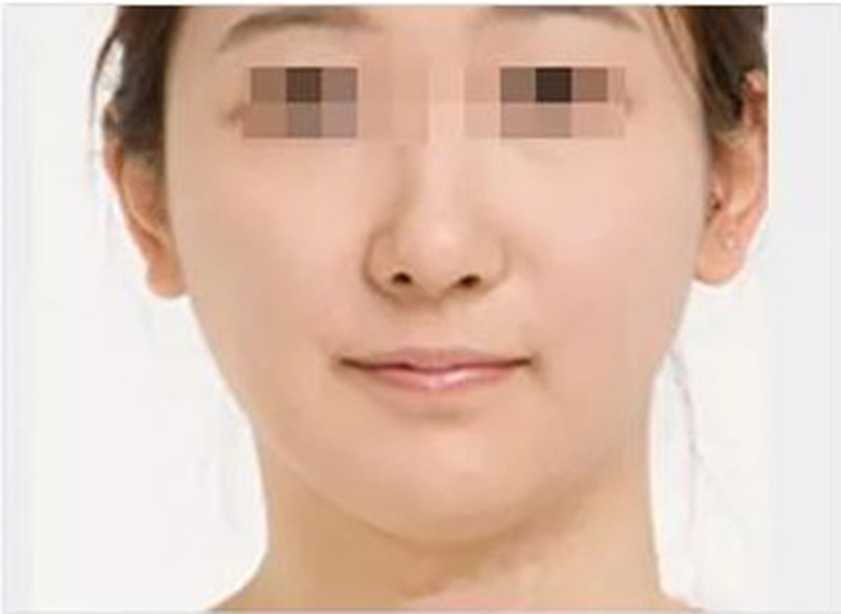 After — Full face · V-line