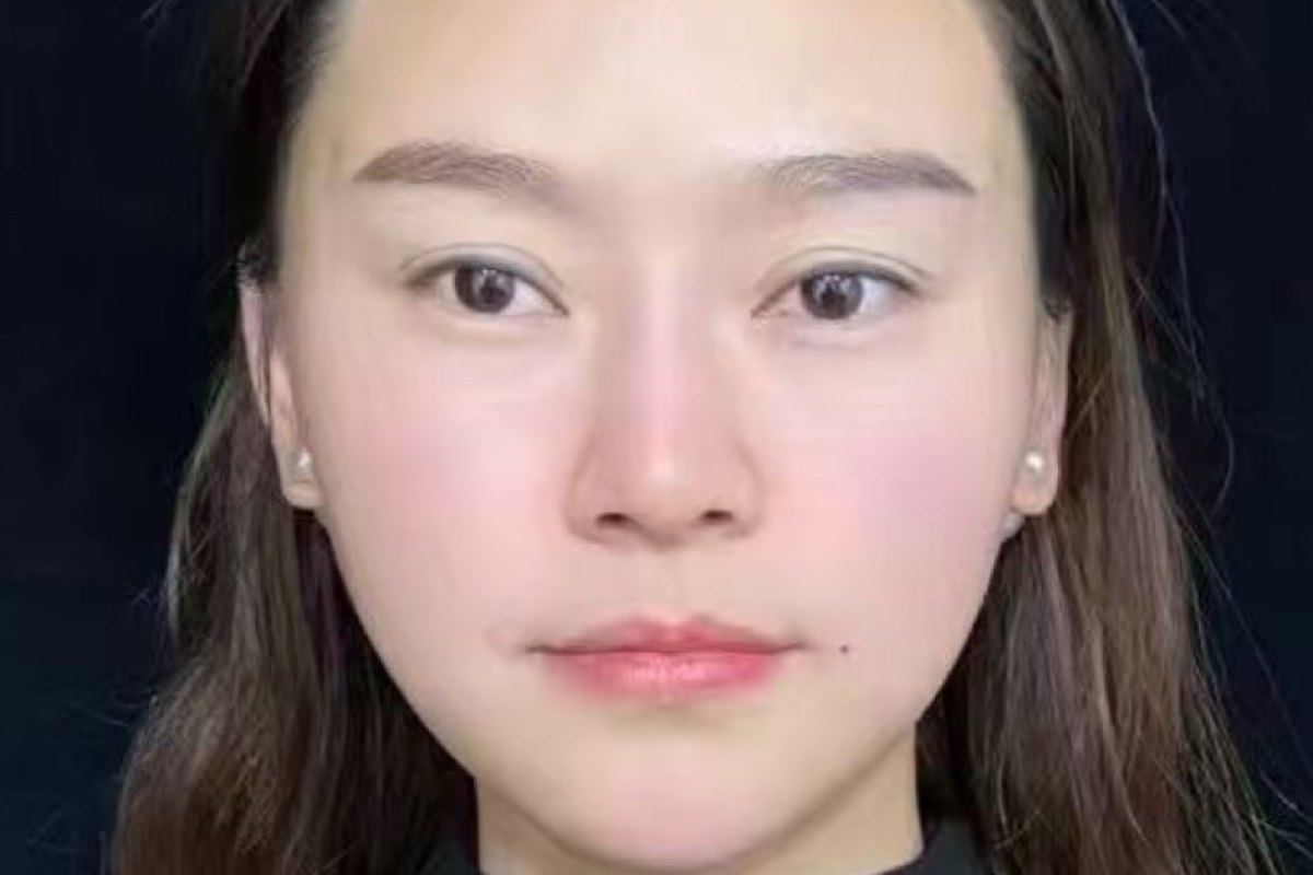 After — Full face · after treatment