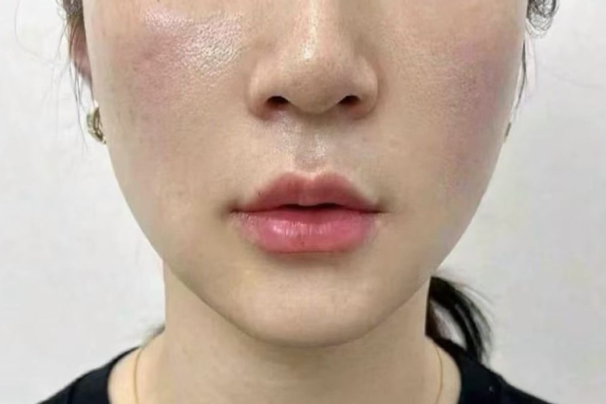 After — Lower face · after treatment